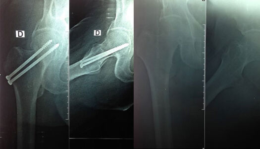 Femoral neck fracture fixed with two screws