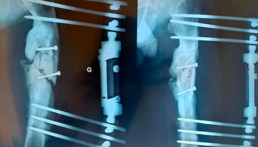 علاج عدم التحام عظمي إنتاني لعظم الفخذ باستخدام طريقة إليزاروف.