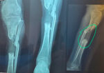 Reconstruction of a Tibial Bone Defect