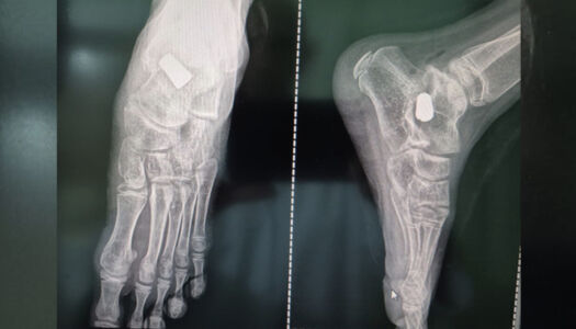 Observation Clinique : Chirurgie du Pied Plat Valgus de l'Enfant