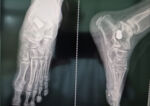 Observation Clinique : Chirurgie du Pied Plat Valgus de l'Enfant